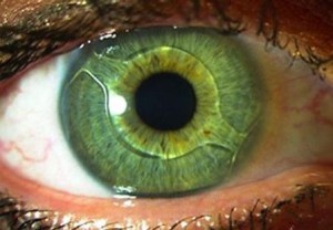 implant ocular pentru vedere